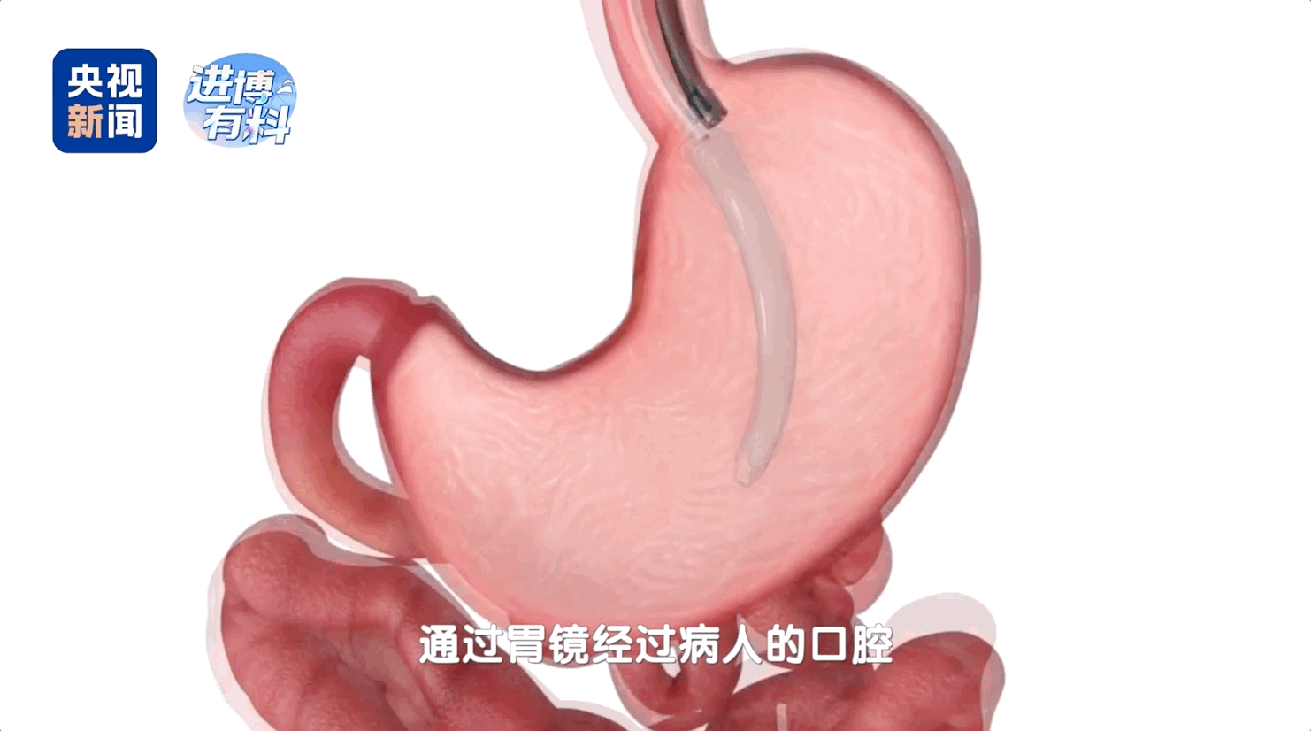 
长春吉大一院黄牛代挂号电话票贩子号贩子网上预约挂号,住院检查加快,进博有料丨减重新选择！一颗球管住你的胃