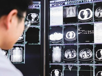 一次平扫CT 筛查多种癌症（大健康观察）