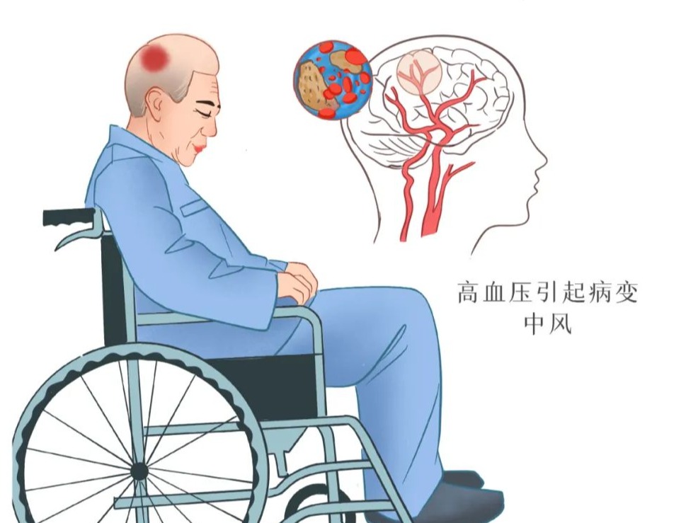 脑梗死患者如需接受高压氧治疗，需要注意什么 | 科普时间